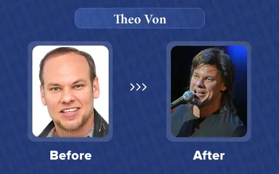 theo von hair transplant