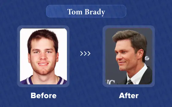 tom brady hair transplant