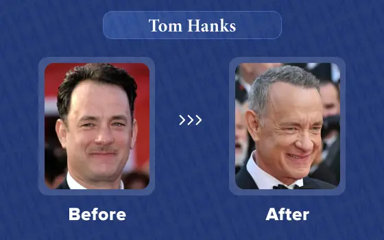 tom hanks hair transplant