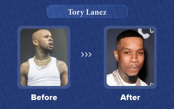tory lanez hair transplant