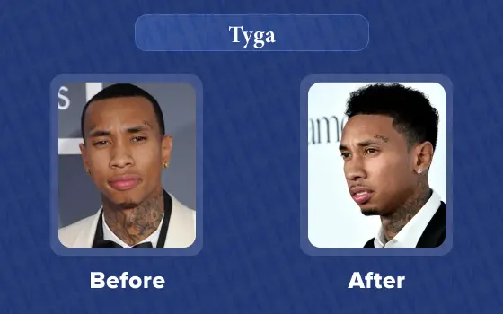 tyga hair transplant