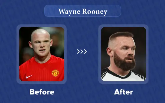 wayne rooney hair transplant