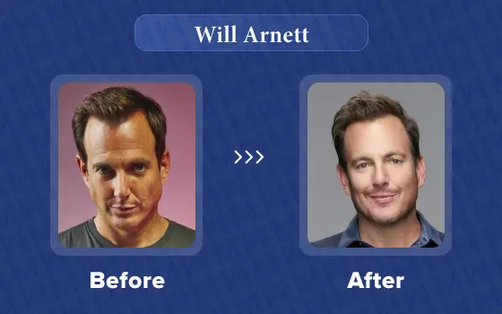 will arnett hair transplant