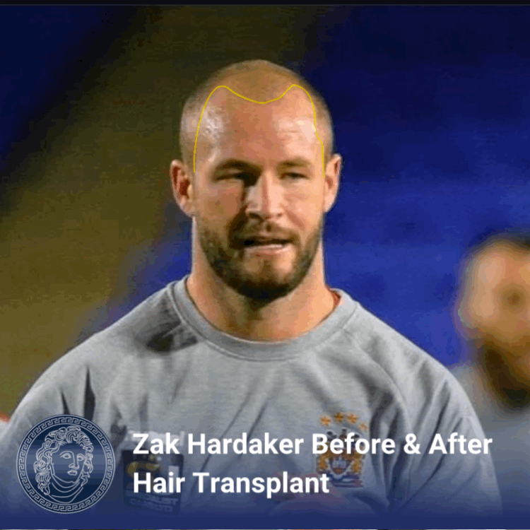 zak hardaker before and after hair transplant