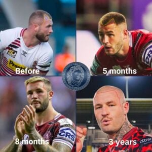 zak hardaker hair transplant growth timeline and results