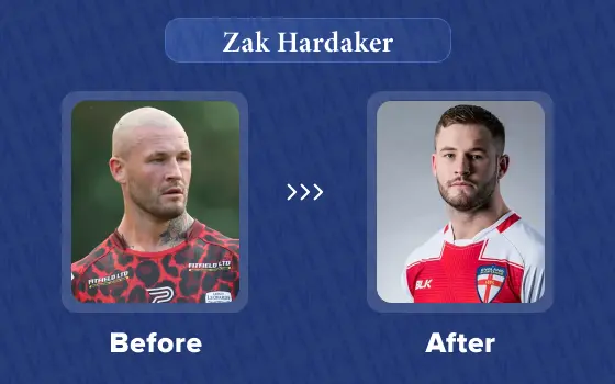 zak hardaker hair transplant
