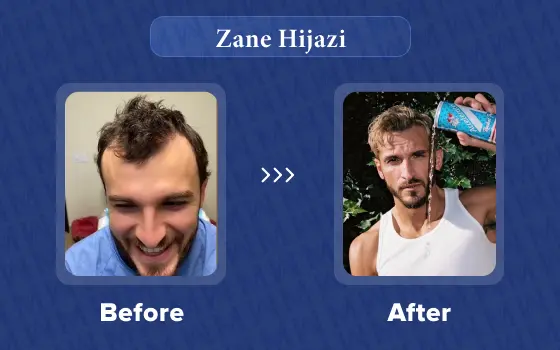 zane hijazi hair transplant