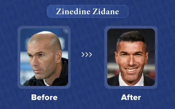 zinedine zidane hair transplant