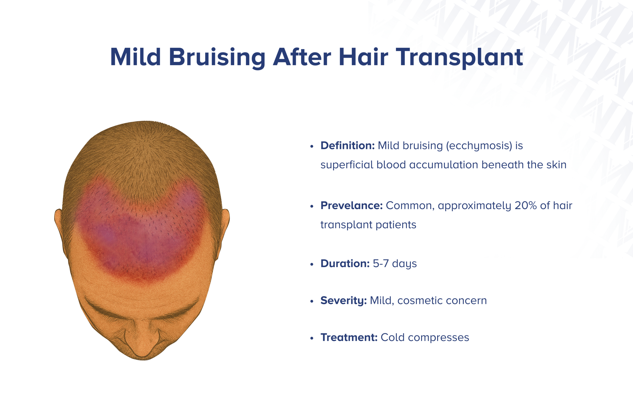 Leichte Blutergüsse nach Haartransplantation