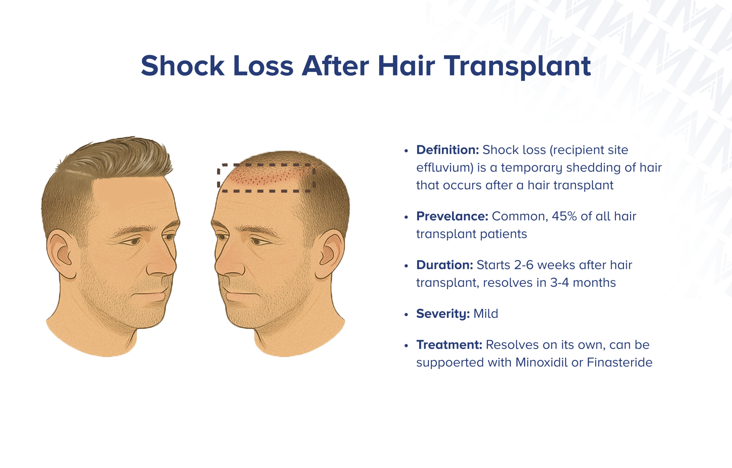 Schockverlust nach Haartransplantation