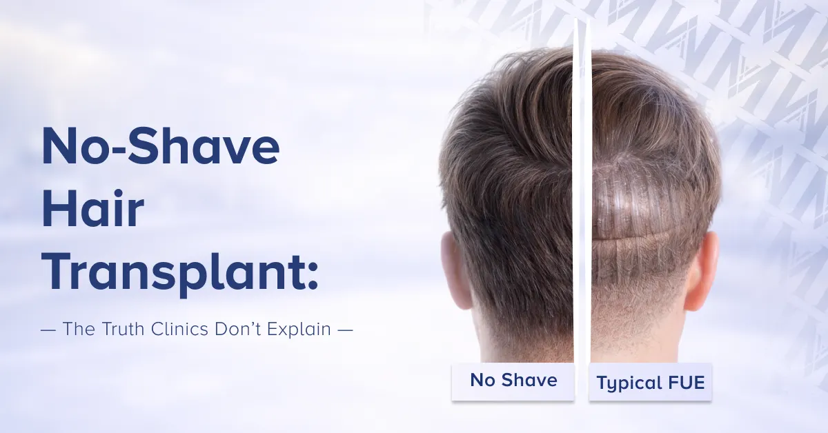 No shave hair transplant