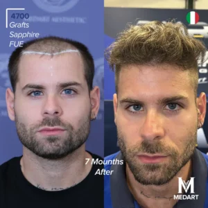 before after hair transplant turkey