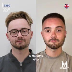 before after hair transplant turkey