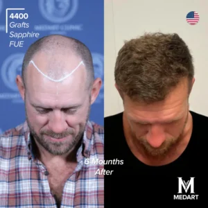 before after hair transplant turkey