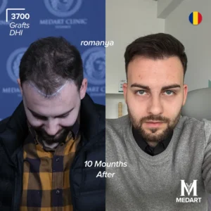 before after hair transplant turkey