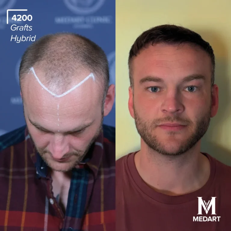 hybrid hair transplant turkey before after 1