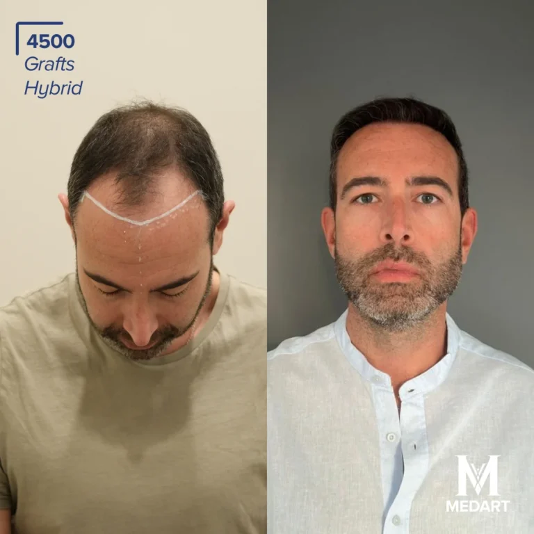 hybrid hair transplant turkey before after 4