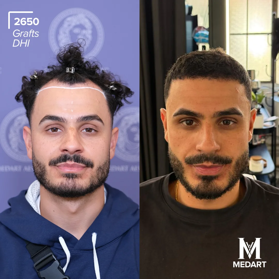 DHI hair transplant turkey before after 1