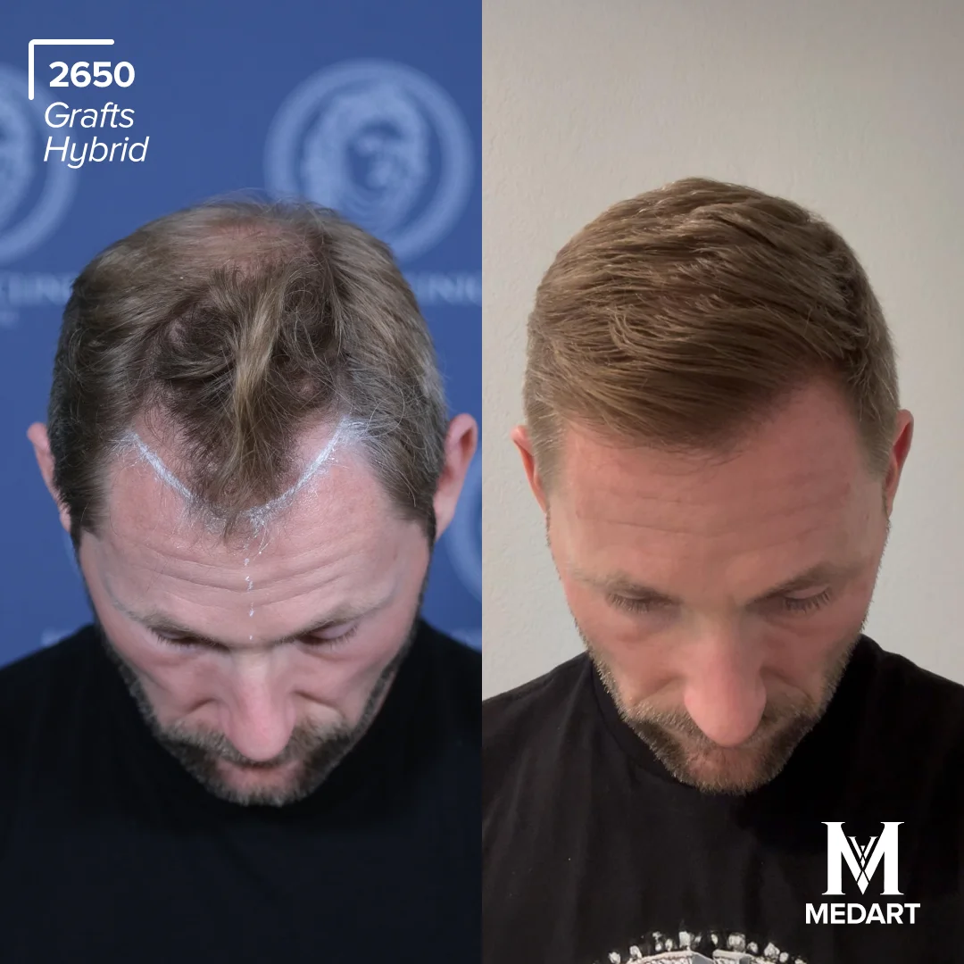hybrid hair transplant turkey before after 1