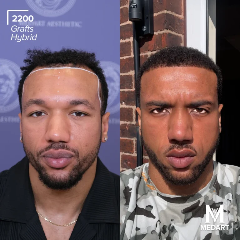 hybrid hair transplant turkey before after 1