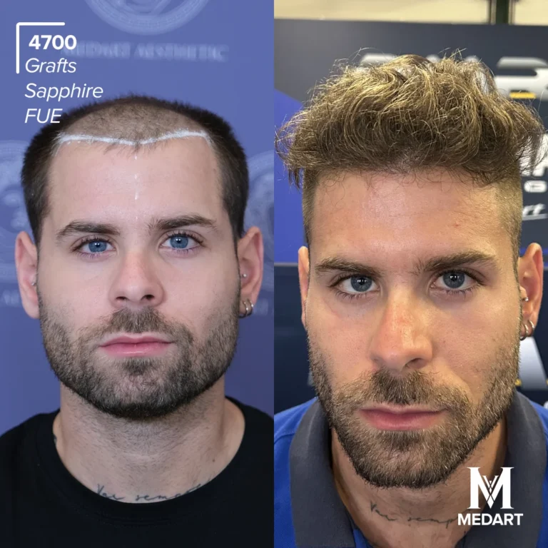 Sapphire FUE Hair transplant before after 4