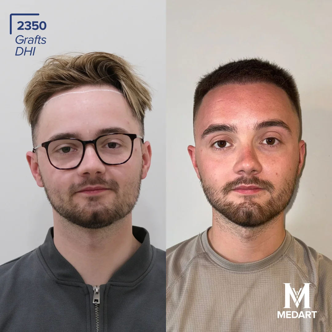 DHI hair transplant turkey before after 2