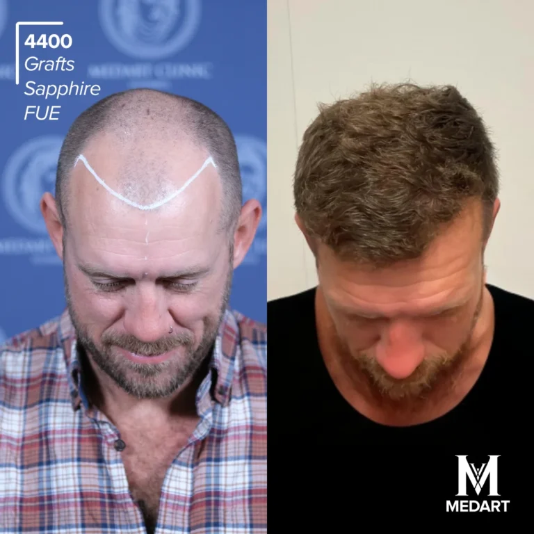 Sapphire FUE Hair transplant before after 3