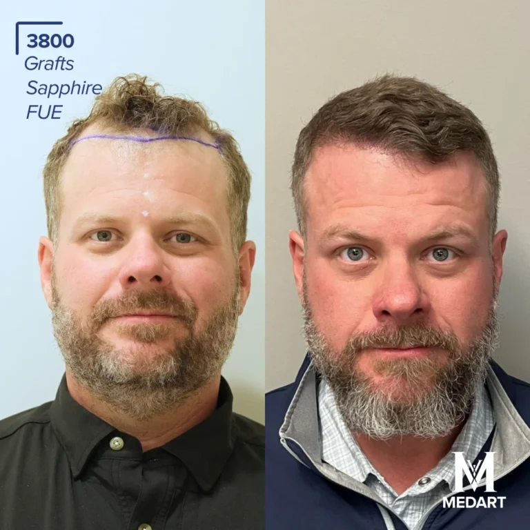 Sapphire FUE Hair transplant before after 2