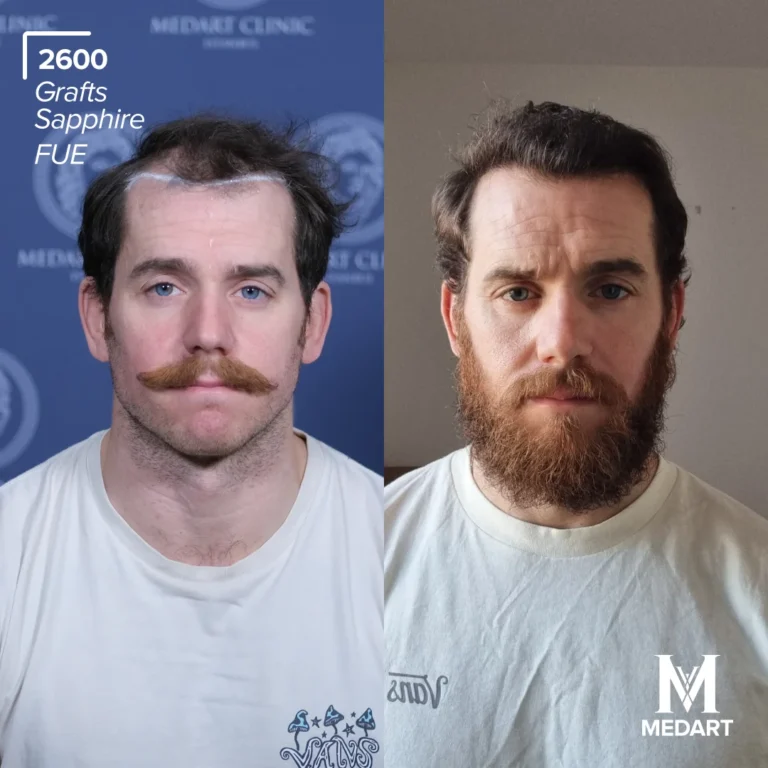 Sapphire FUE Hair transplant before after 1