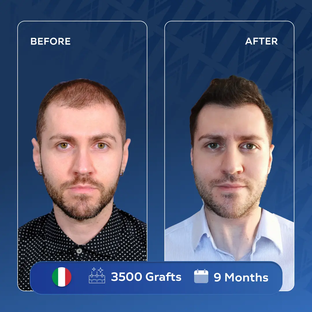 Nicolo Zugnoni before and after hair transplant at MedArt Hair - 3500 graft hairline restoration