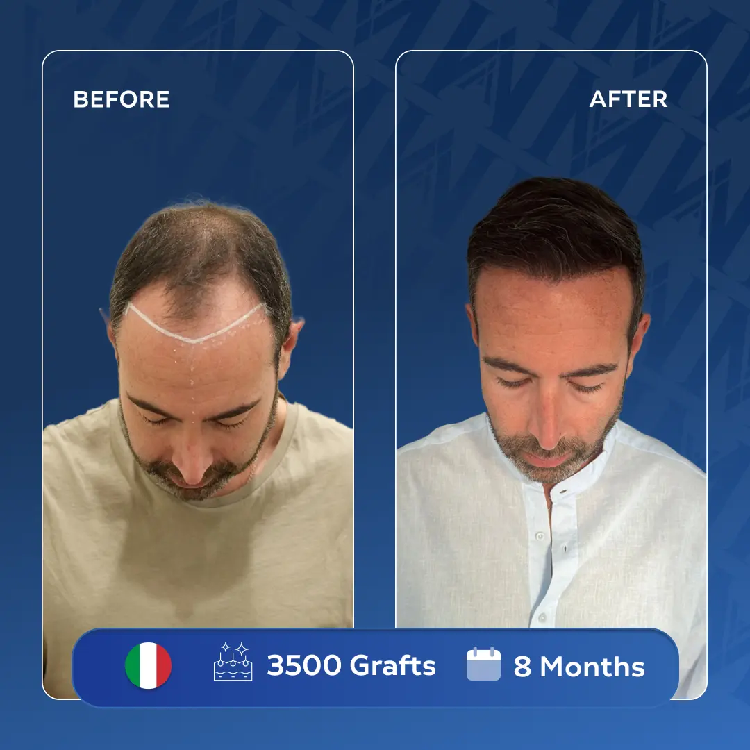 Felice Asta Haartransplantation Reise Türkei MedArt Hair