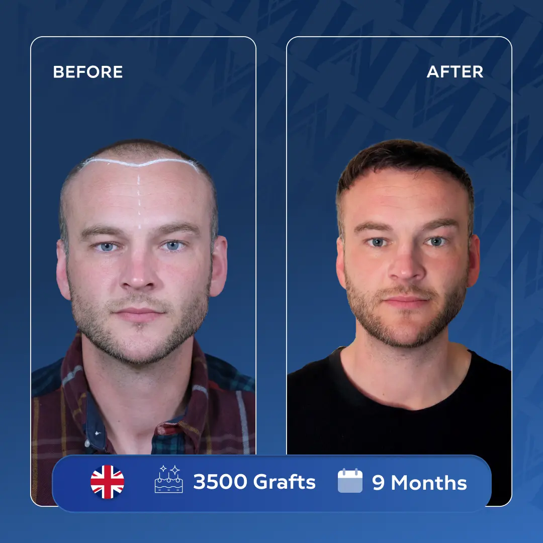 John Thompson UK Patient Haartransplantation Vorher Nachher MedArt Hair 3500 Grafts