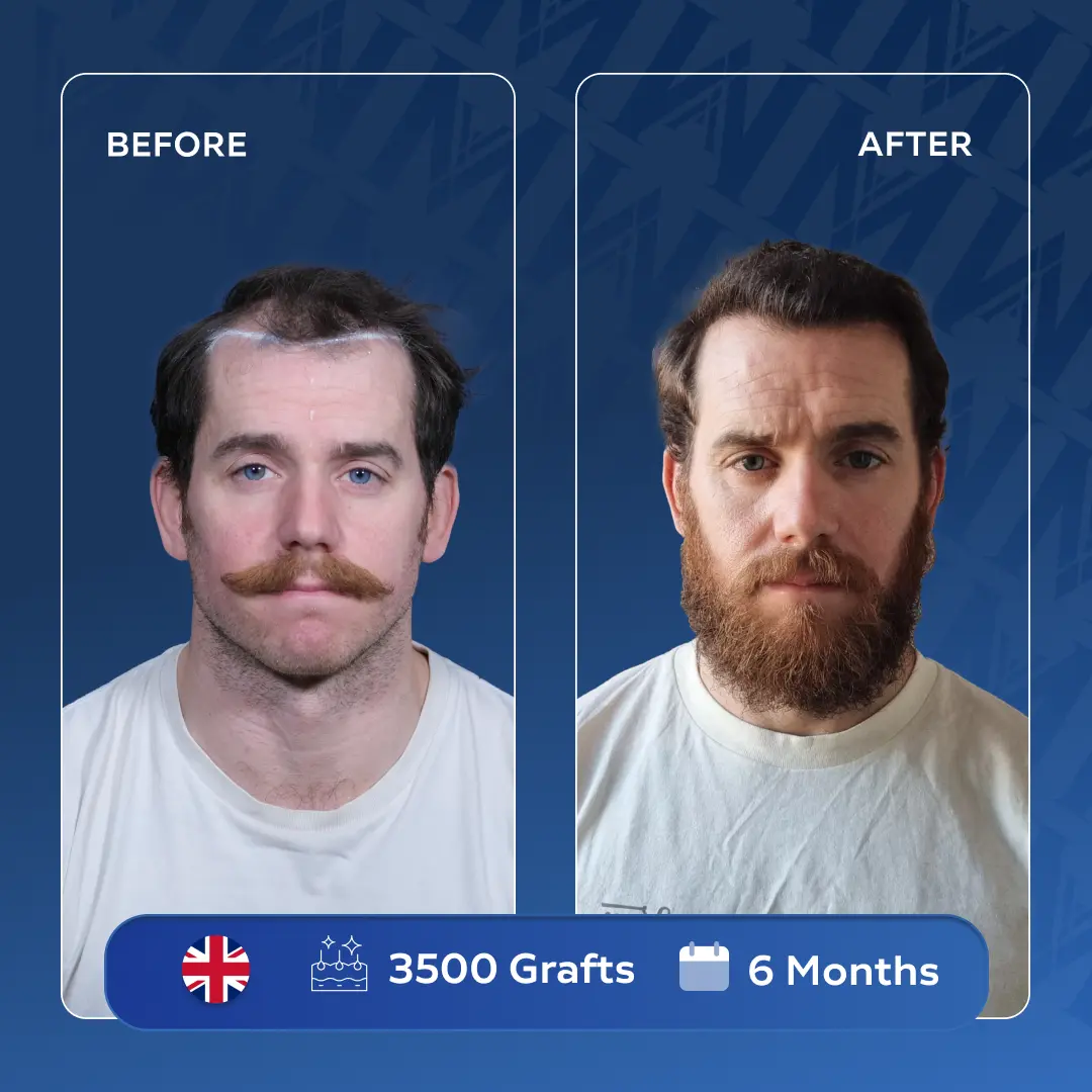 Ryan Haartransplantation in der Türkei natürliches Dichte-Ergebnis MedArt Hair