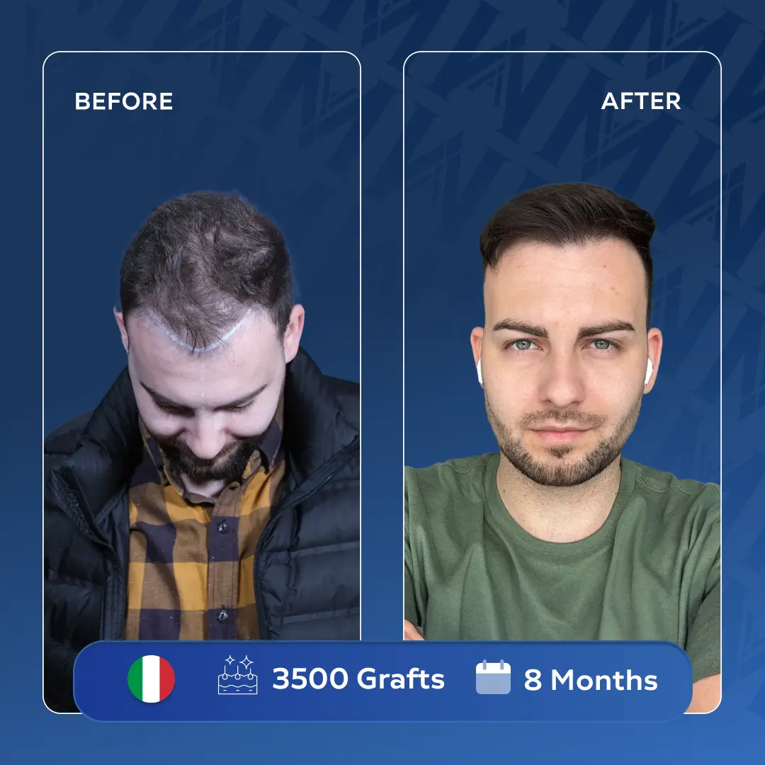 Momchil Italien Haartransplantation Ergebnis MedArt Hair Vorher Nachher