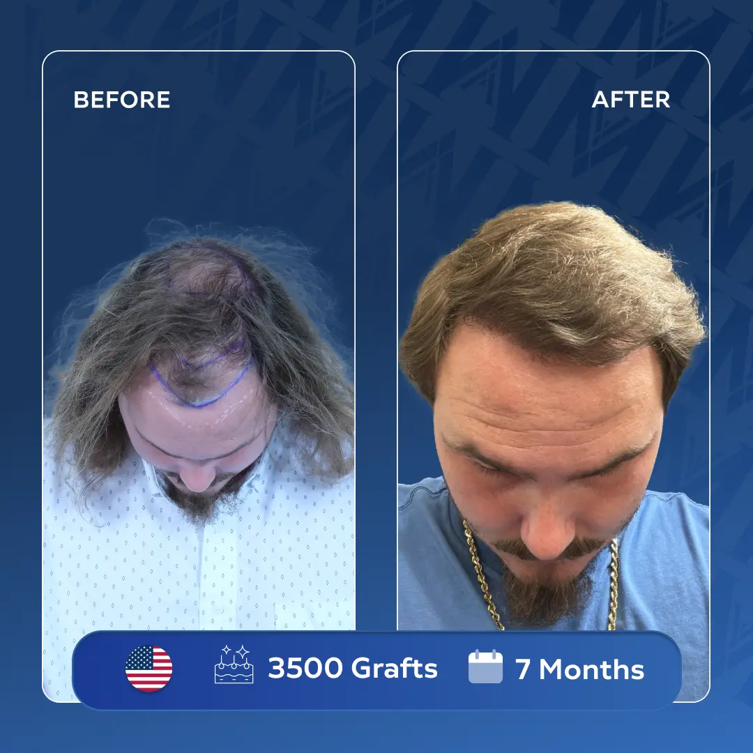 Benjamin Whitaker hair transplant transformation in Turkey - 3500 graft result MedArt Hair