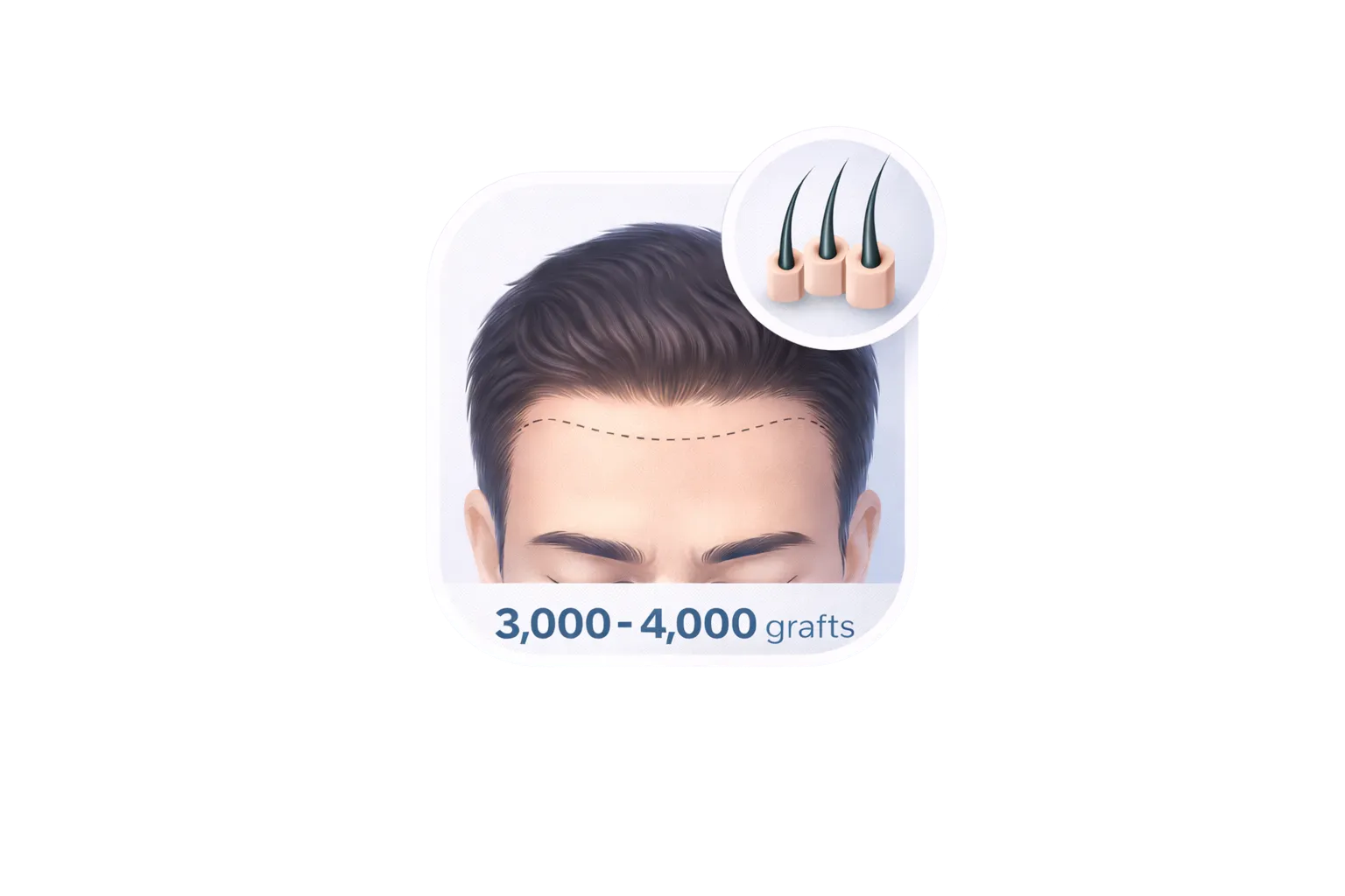 3000 – 4000 graft