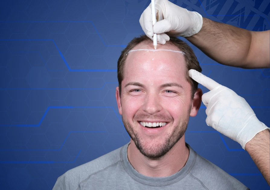 DHI Hair Transplant Turkey