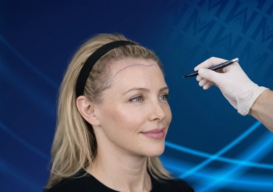 Hair Transplant for Woman