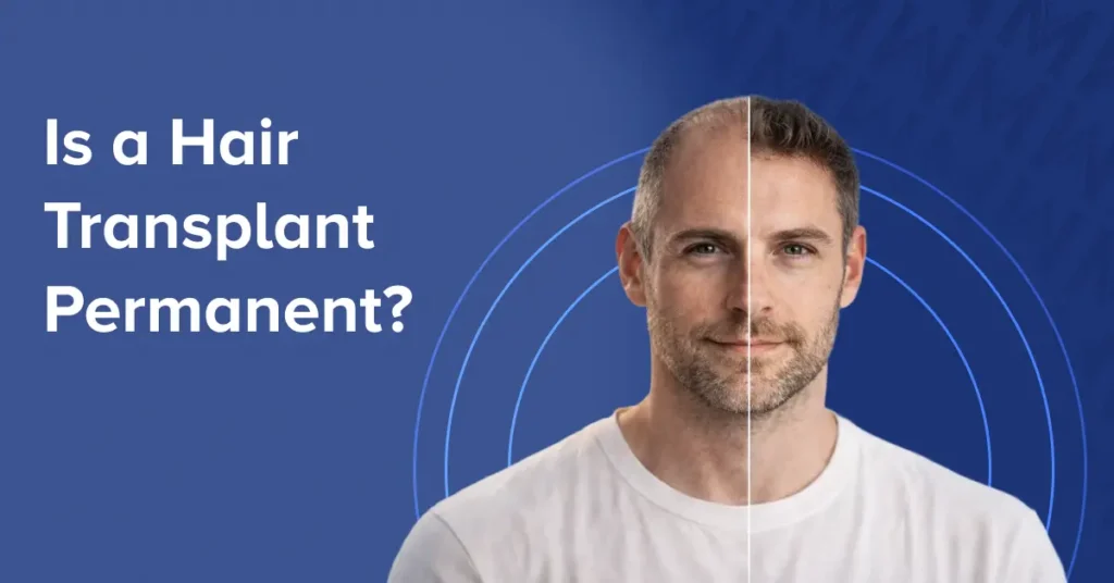 Is Hair Transplant Permanent? How Long Results Last