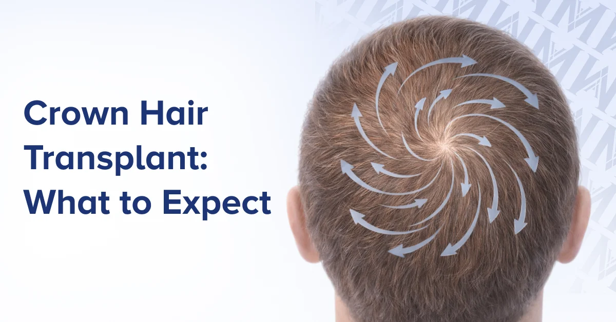 Crown Hair Transplant_ What to Expect