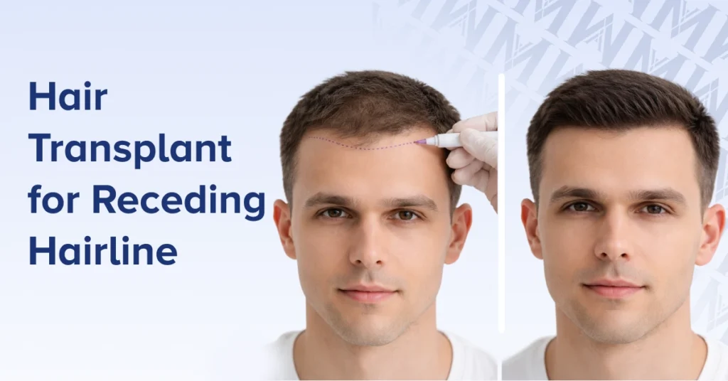 Hair Transplant for Receding Hairline