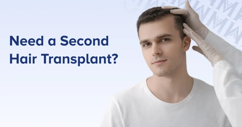 Need a Second Hair Transplant?