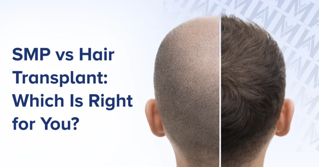 SMP vs Hair Transplant_ Which Is Right for You