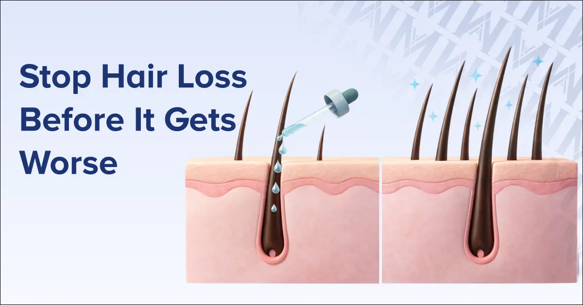 Stop Hair Loss Before It Gets Worse Minoxidil Finasteride