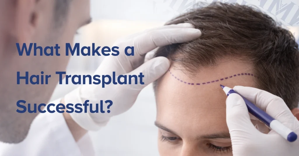 What Makes a Hair Transplant Successful