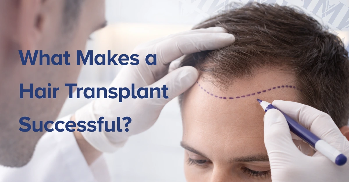 What Makes a Hair Transplant Successful