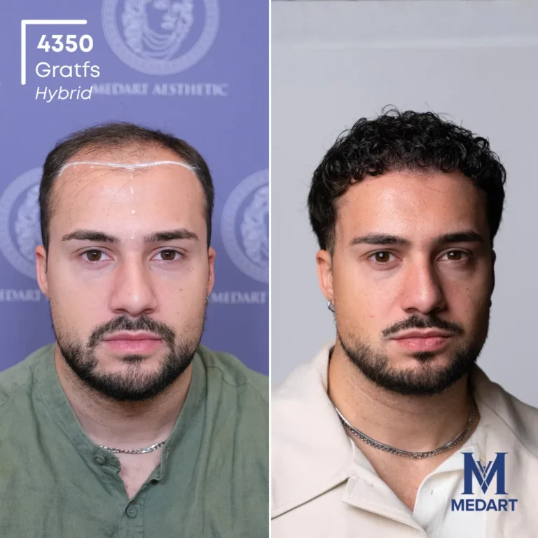 Andrea Petrecca Hybrid hair transplant before and after photo 1, 4350 grafts at MedArt Hair