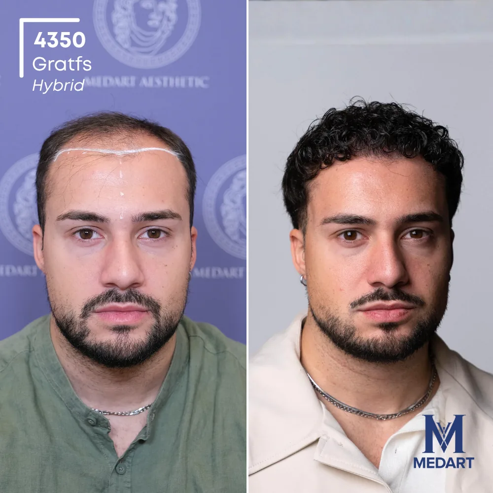 Andrea Petrecca Hybride haartransplantatie voor-en-na-foto 1, 4350 grafts bij Medart Hair