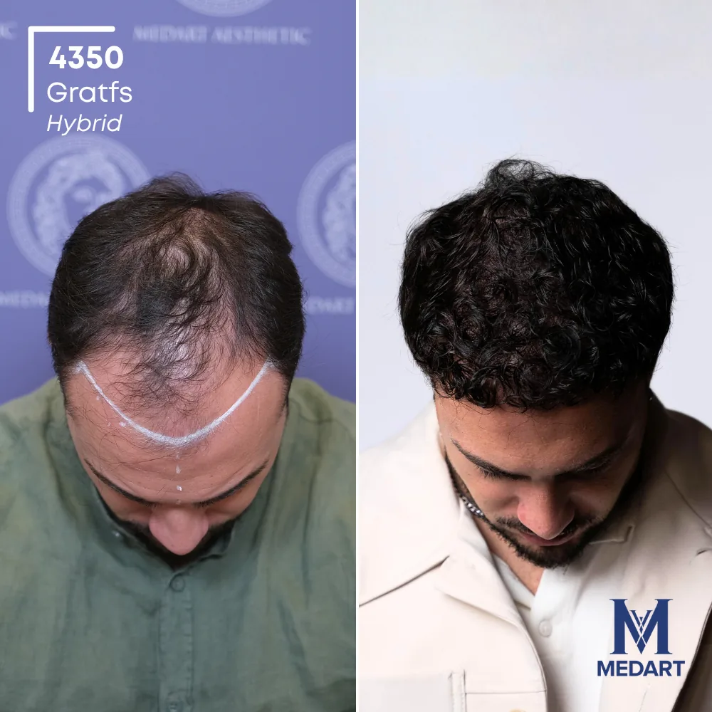 Andrea Petrecca Hybride haartransplantatie voor-en-na-foto 2, 4350 grafts bij Medart Hair