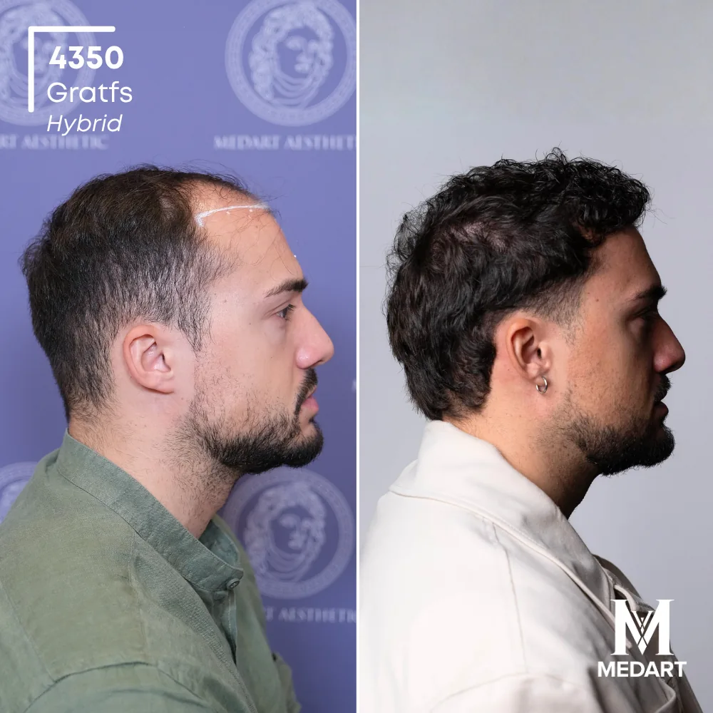 Andrea Petrecca Hybride haartransplantatie voor-en-na-foto 3, 4350 grafts bij Medart Hair